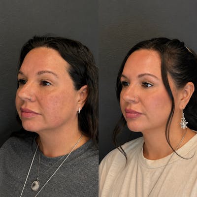Combination Before & After Gallery - Patient 506608 - Image 1