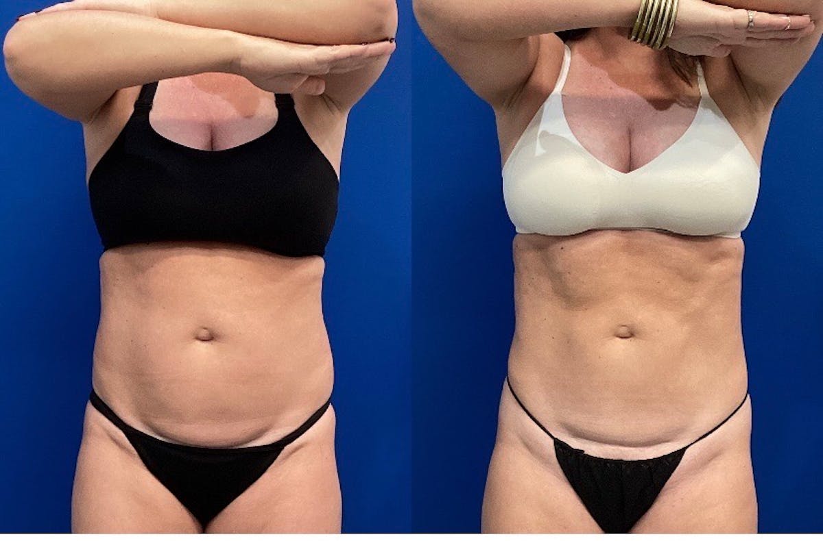 CoolSculpt Before & After Gallery - Patient 144378 - Image 1