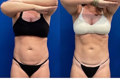 CoolSculpt Before & After Gallery - Patient 144378 - Image 1