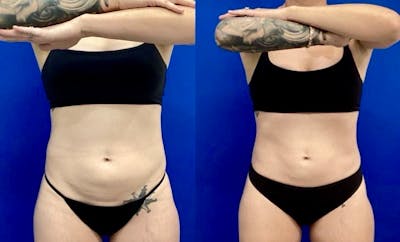 CoolSculpt Before & After Gallery - Patient 202517 - Image 1