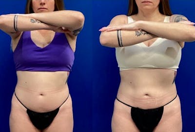 CoolSculpt Before & After Gallery - Patient 208102 - Image 1