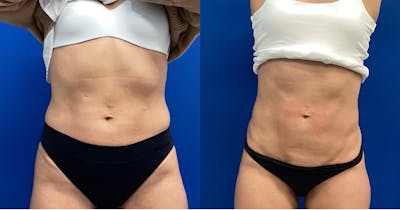 Emsculpt Before & After Gallery - Patient 546581 - Image 1