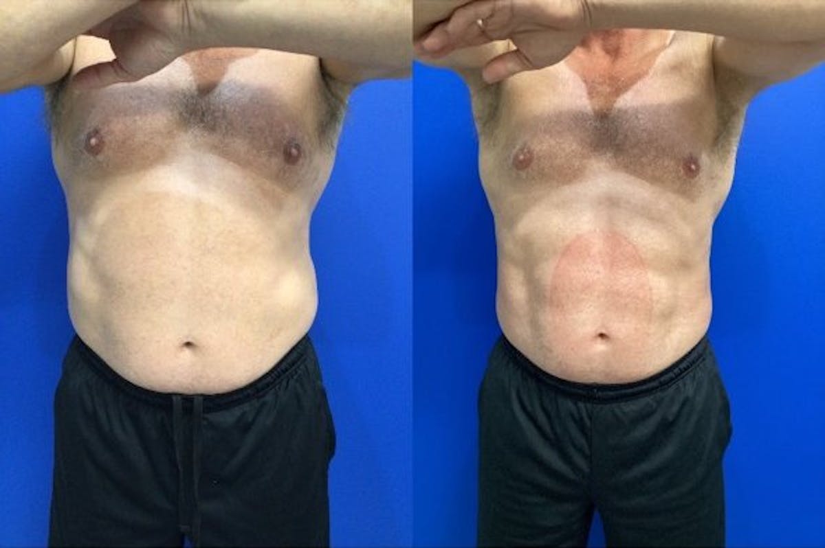 Emsculpt Before & After Gallery - Patient 589290 - Image 1
