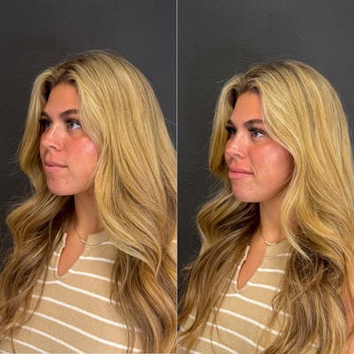 Facial Fillers Before & After Gallery - Patient 315143 - Image 1
