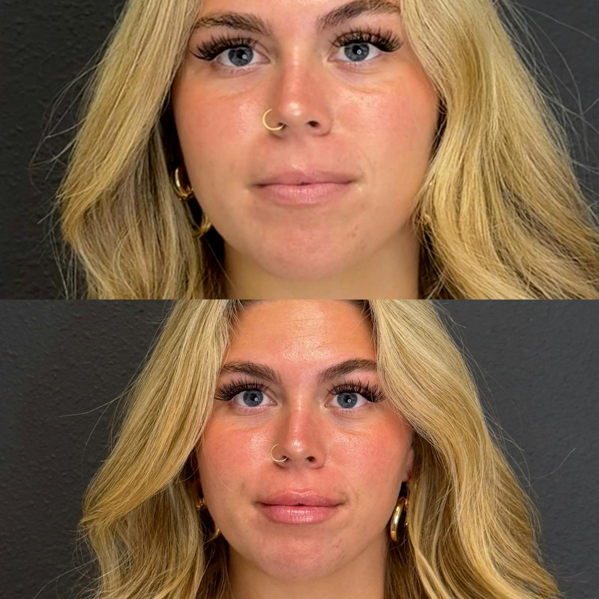 Facial Fillers Before & After Gallery - Patient 315143 - Image 2