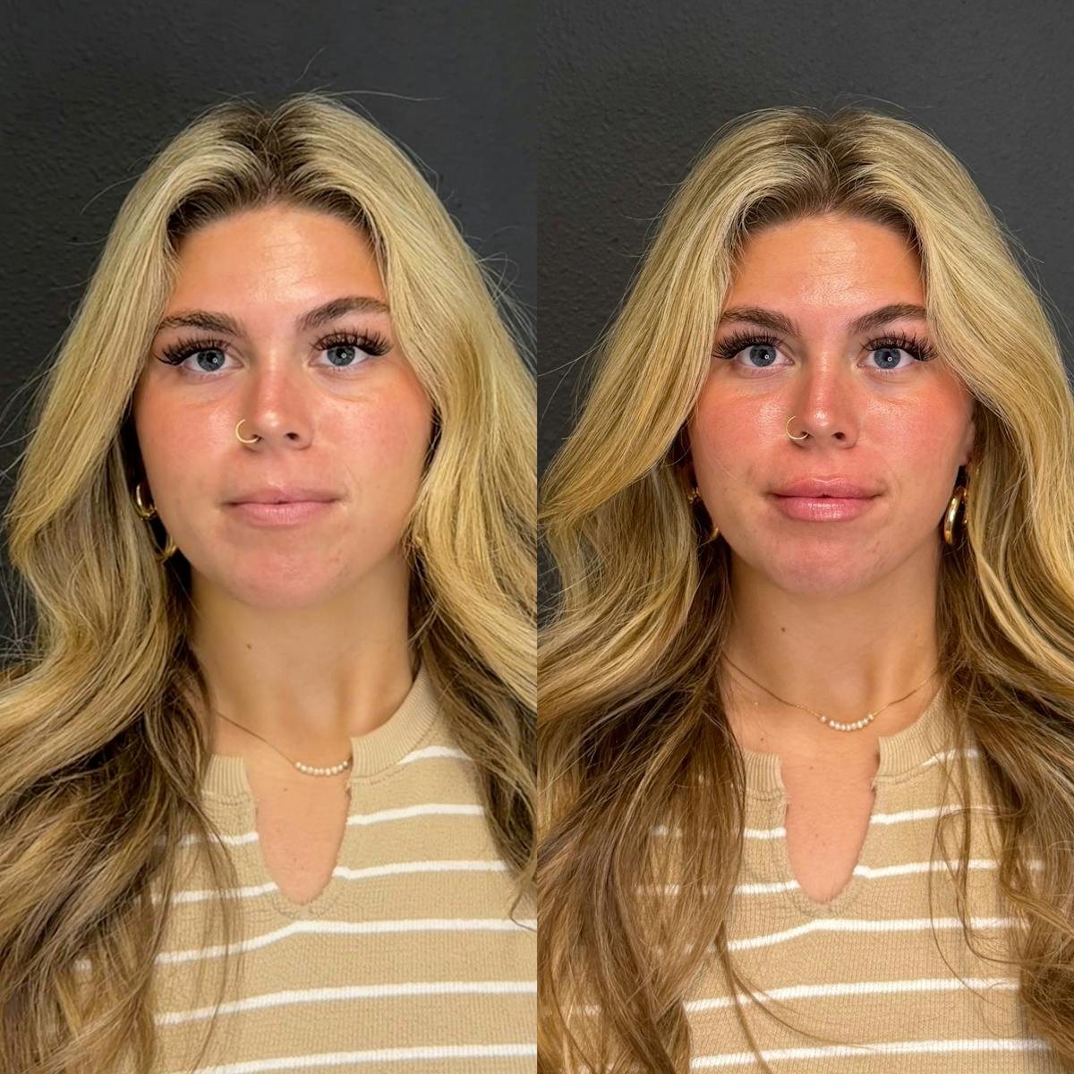Facial Fillers Before & After Gallery - Patient 315143 - Image 3
