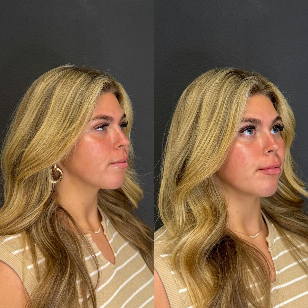 Facial Fillers Before & After Gallery - Patient 315143 - Image 4