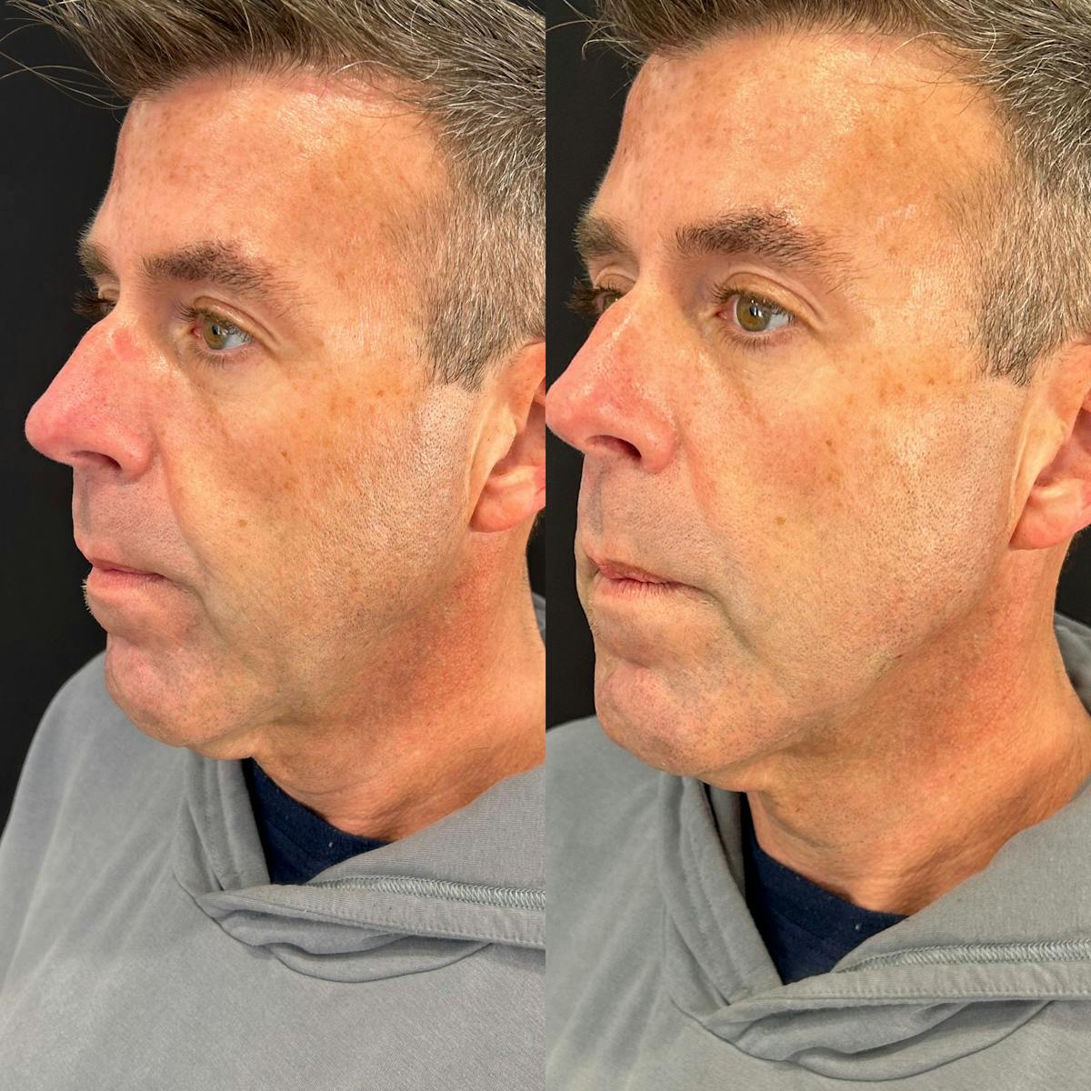 Facial Fillers Before & After Gallery - Patient 192798 - Image 1