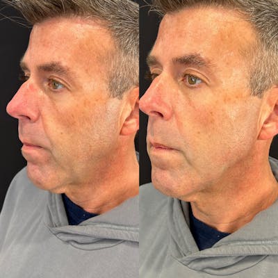Facial Fillers Before & After Gallery - Patient 192798 - Image 1