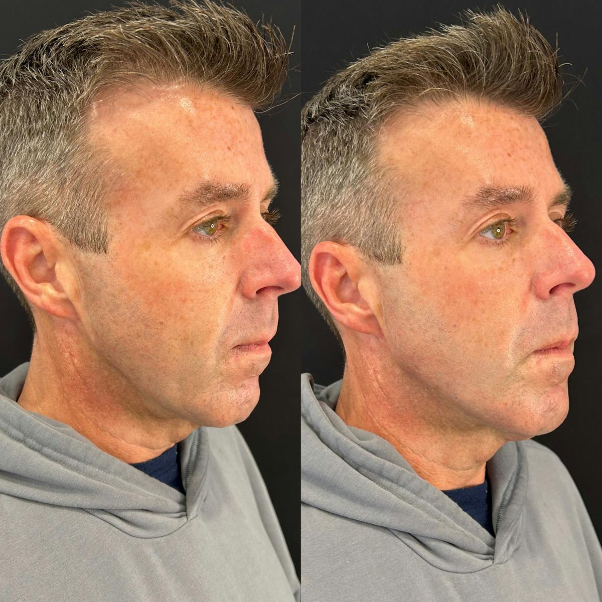 Facial Fillers Before & After Gallery - Patient 192798 - Image 2