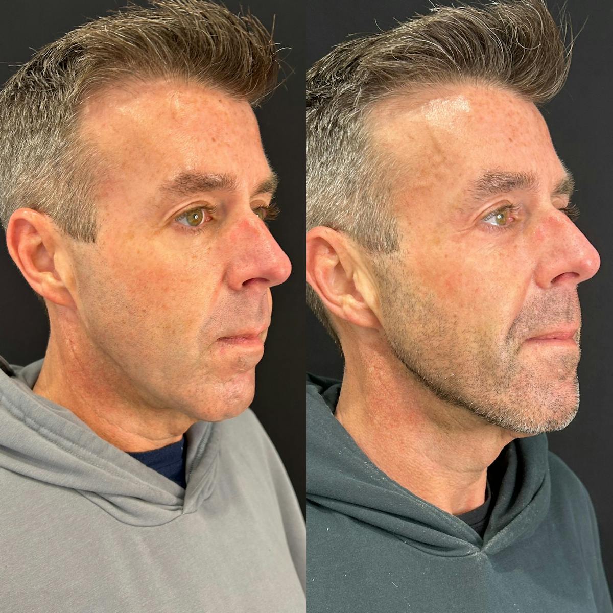 Facial Fillers Before & After Gallery - Patient 192798 - Image 3