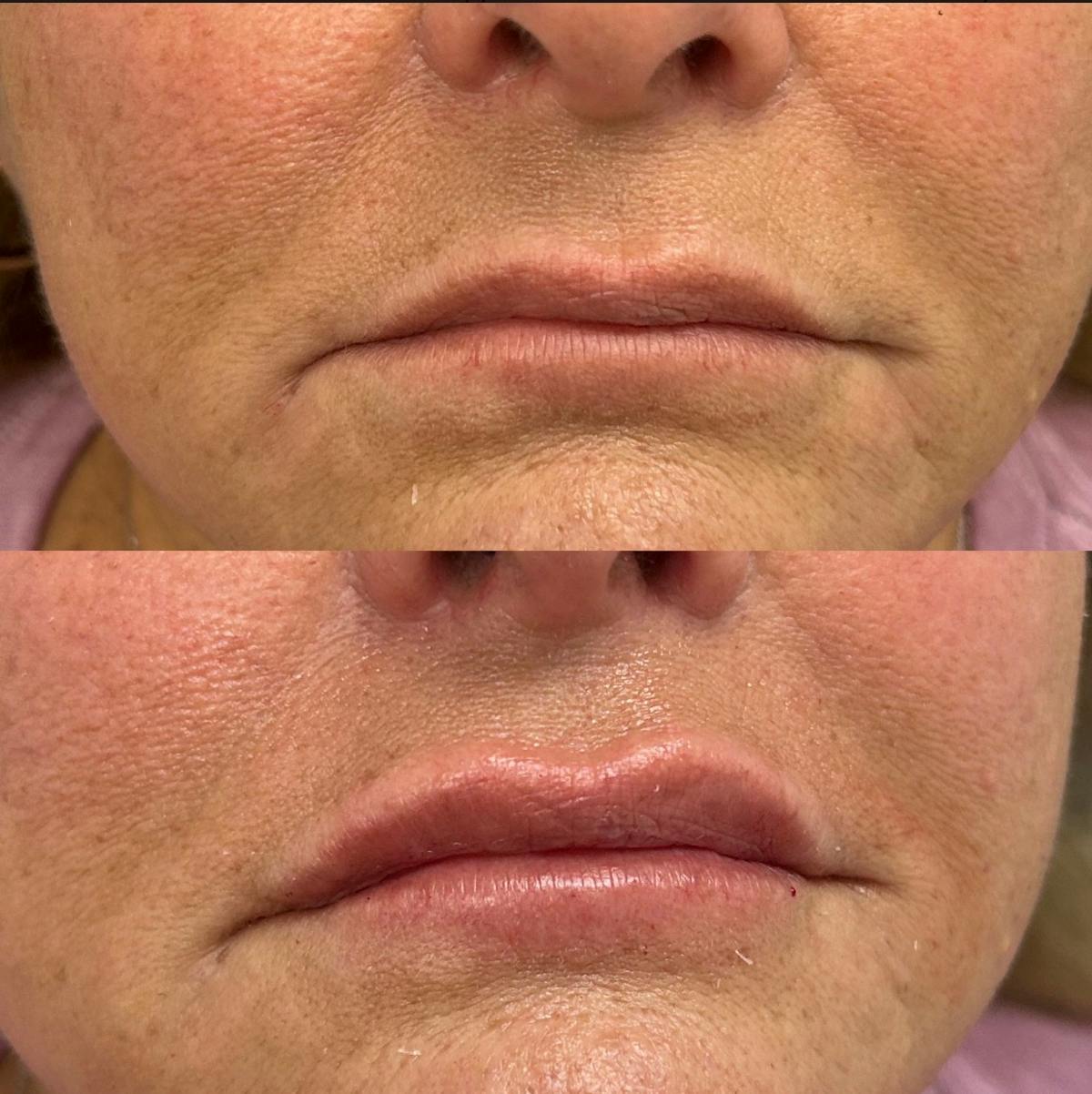 Lip Fillers Before & After Gallery - Patient 703716 - Image 1