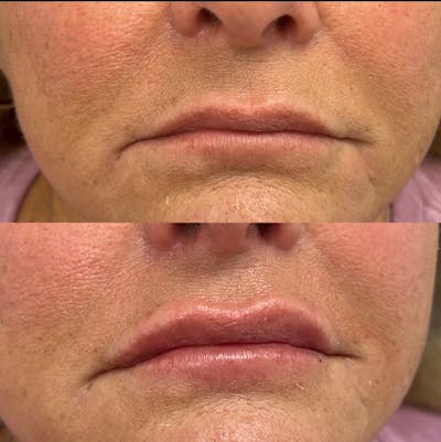Lip Fillers Before & After Gallery - Patient 703716 - Image 1