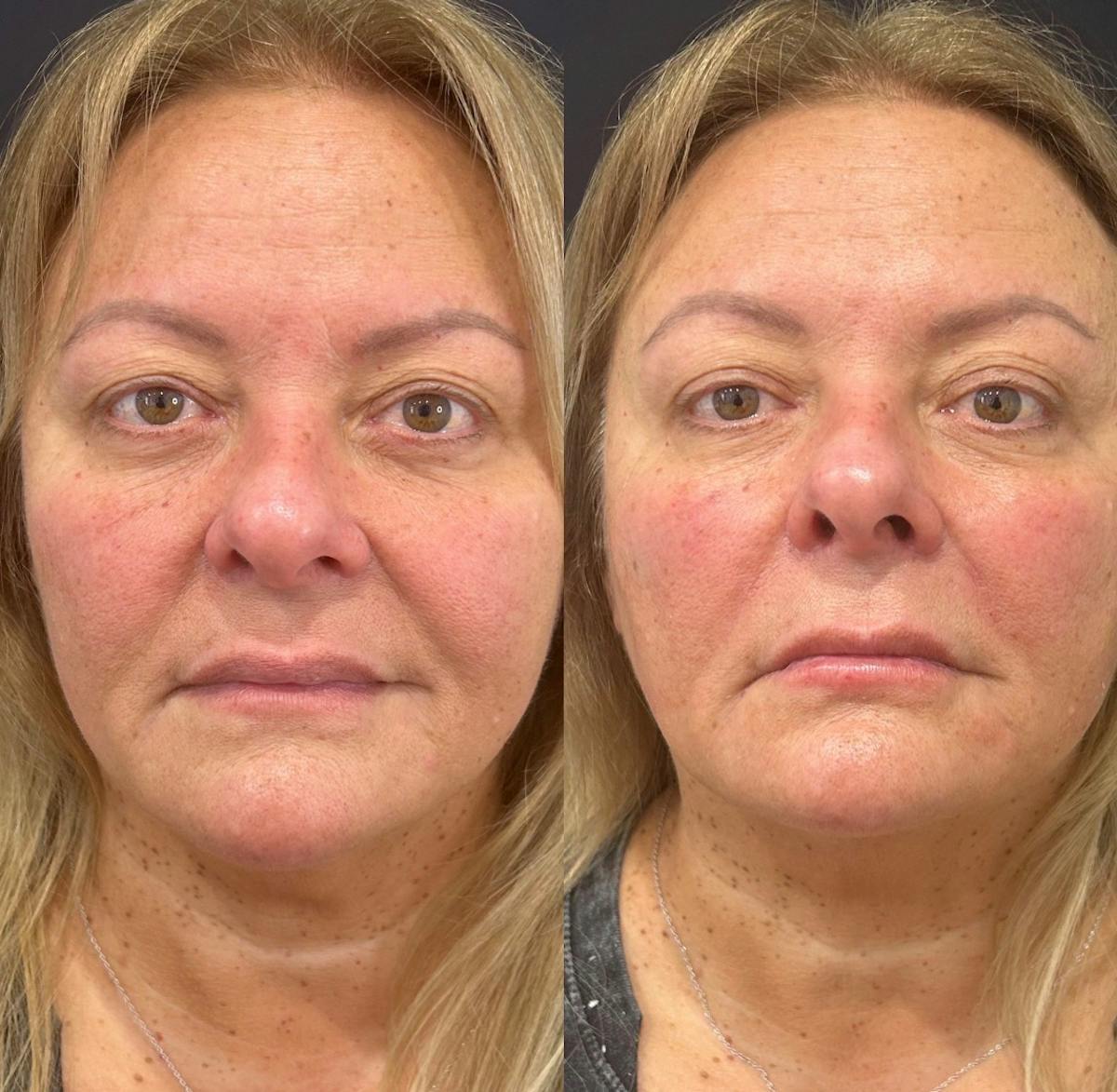 Lip Fillers Before & After Gallery - Patient 703716 - Image 2