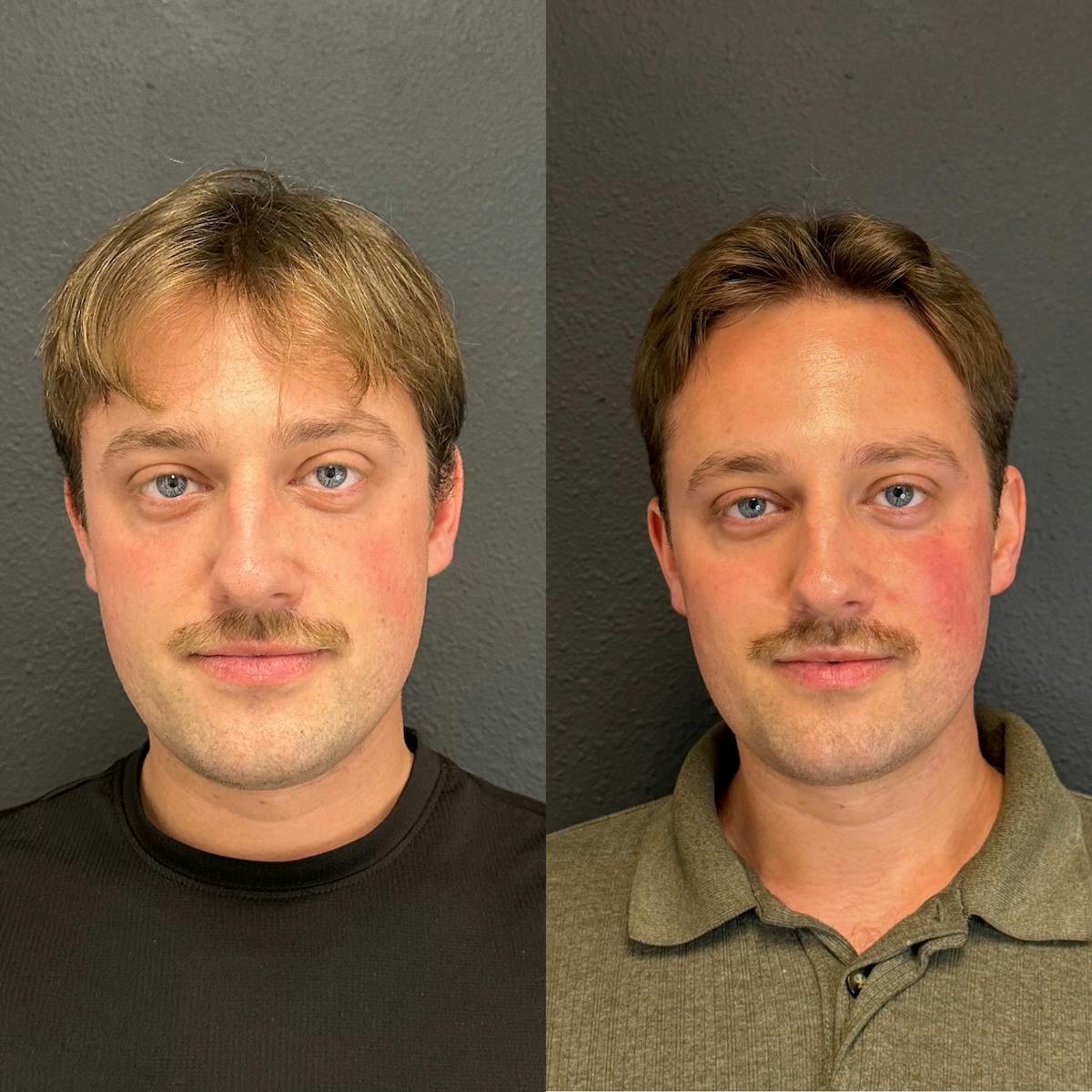 Facial Fillers Before & After Gallery - Patient 211626 - Image 1
