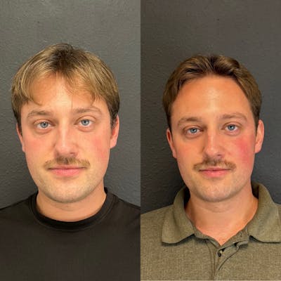 Facial Fillers Before & After Gallery - Patient 211626 - Image 1