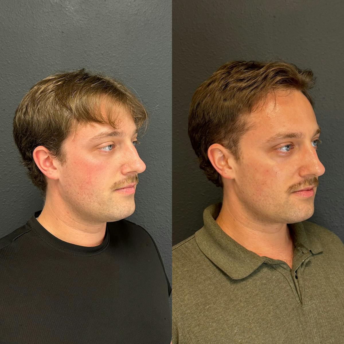 Facial Fillers Before & After Gallery - Patient 211626 - Image 2