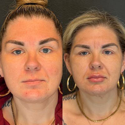 Facial Fillers Before & After Gallery - Patient 174997 - Image 1