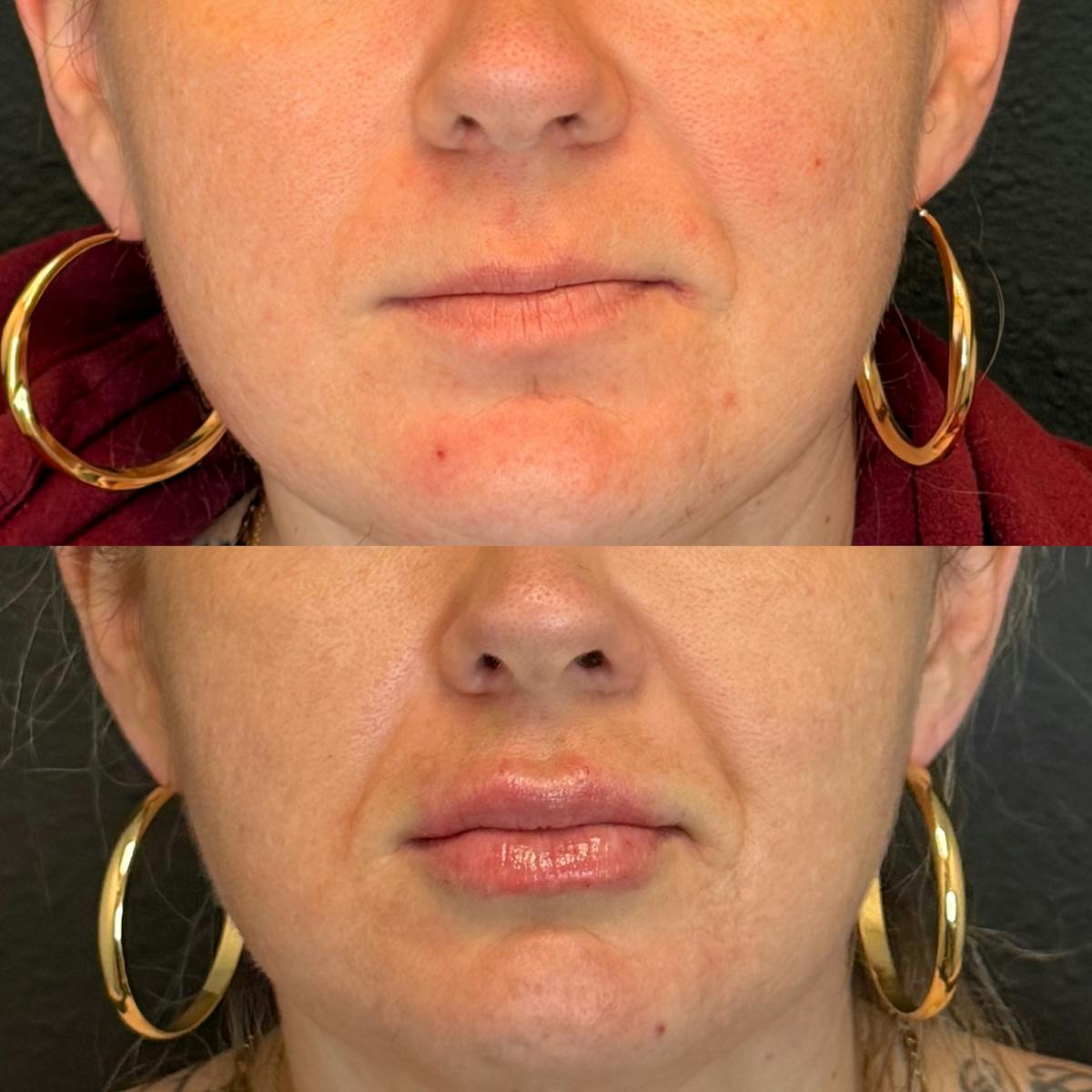 Facial Fillers Before & After Gallery - Patient 174997 - Image 2