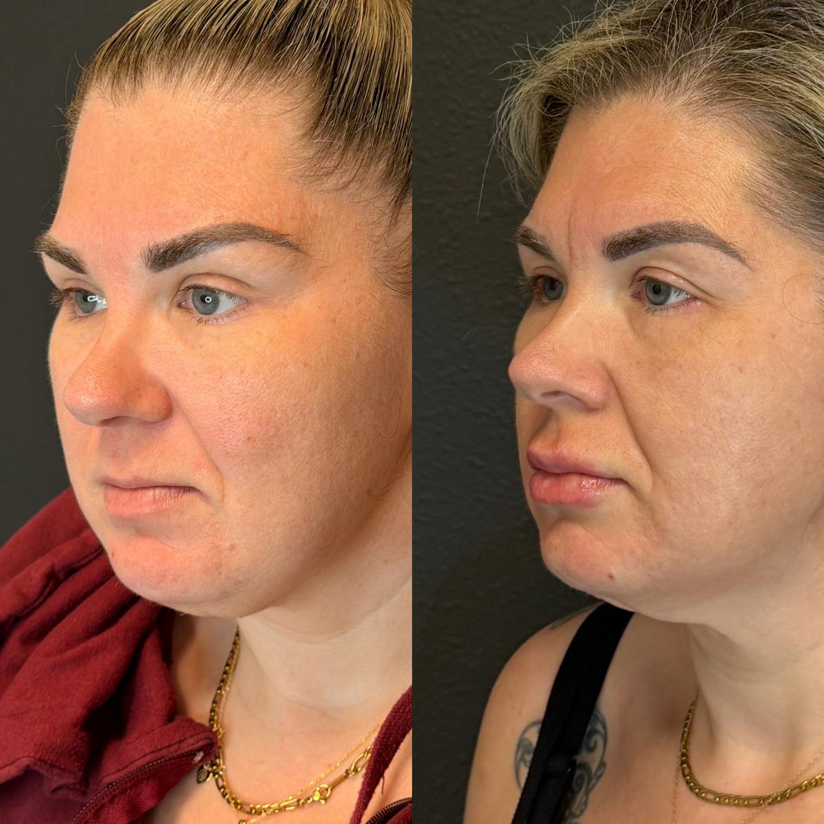 Facial Fillers Before & After Gallery - Patient 174997 - Image 3