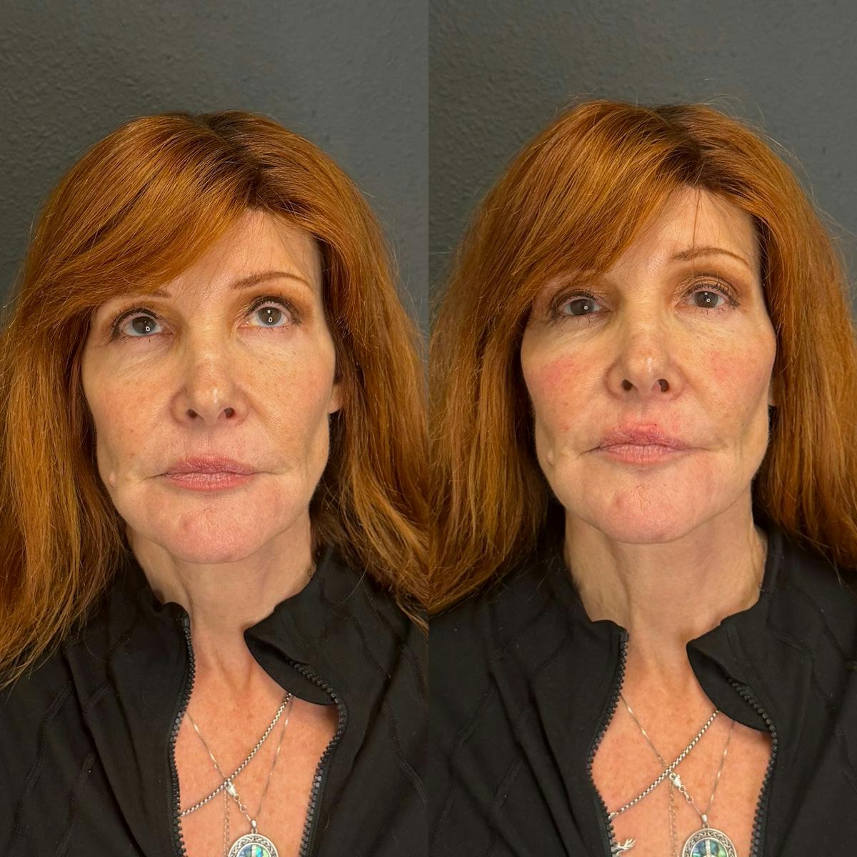 Facial Fillers Before & After Gallery - Patient 501190 - Image 1
