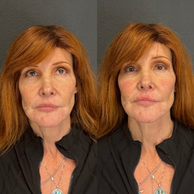 Facial Fillers Before & After Gallery - Patient 501190 - Image 1