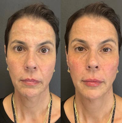Facial Fillers Before & After Gallery - Patient 291854 - Image 1