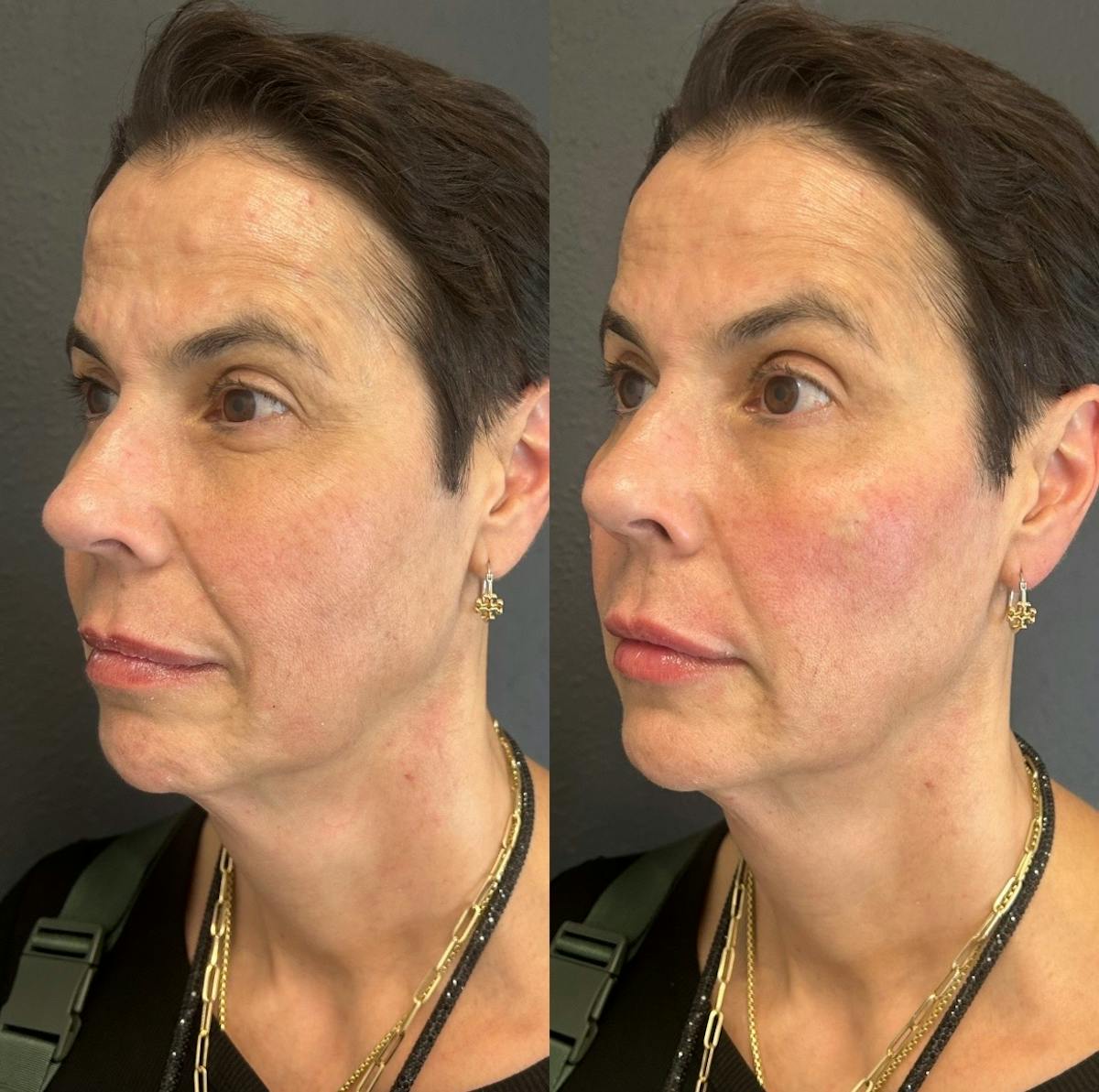 Facial Fillers Before & After Gallery - Patient 291854 - Image 2