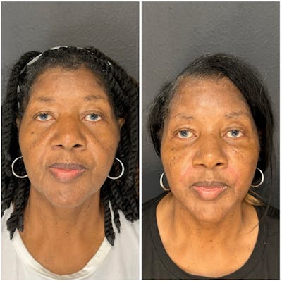 Facial Fillers Before & After Gallery - Patient 401933 - Image 1