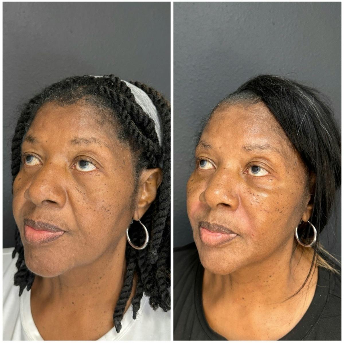 Facial Fillers Before & After Gallery - Patient 401933 - Image 2