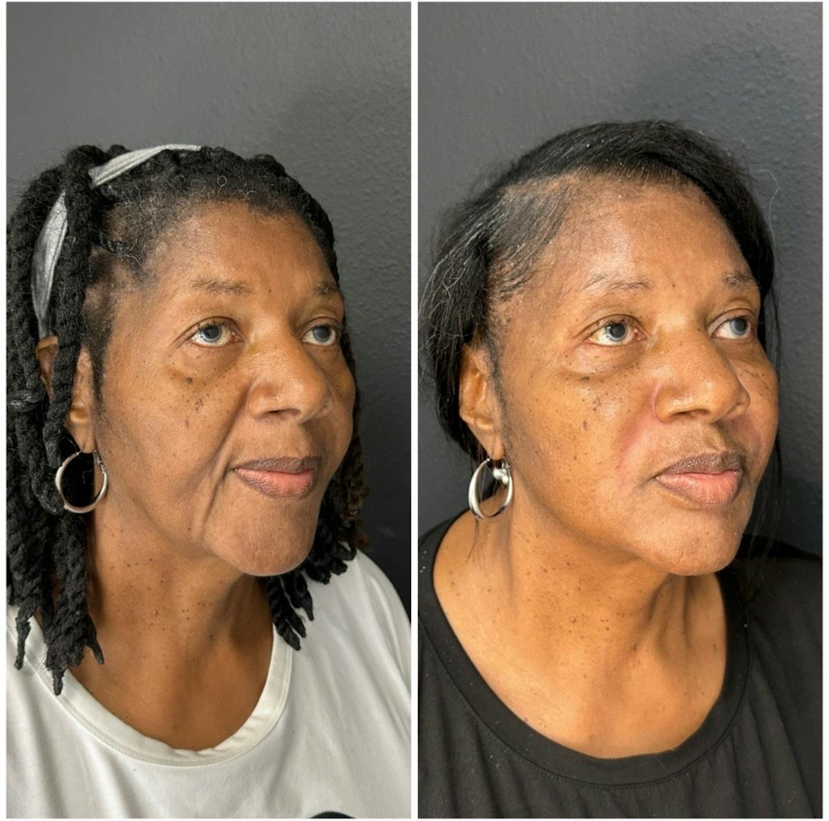Facial Fillers Before & After Gallery - Patient 401933 - Image 3