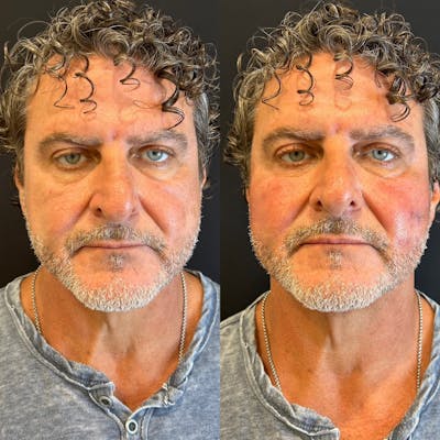 Facial Fillers Before & After Gallery - Patient 165241 - Image 1