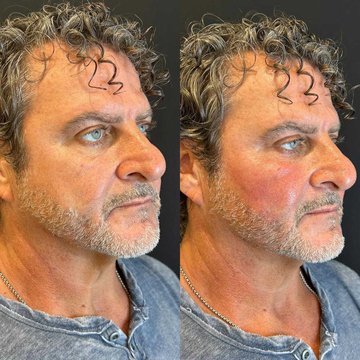 Facial Fillers Before & After Gallery - Patient 165241 - Image 2