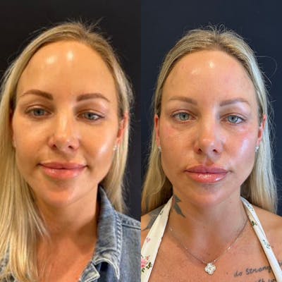 Facial Fillers Before & After Gallery - Patient 328307 - Image 1