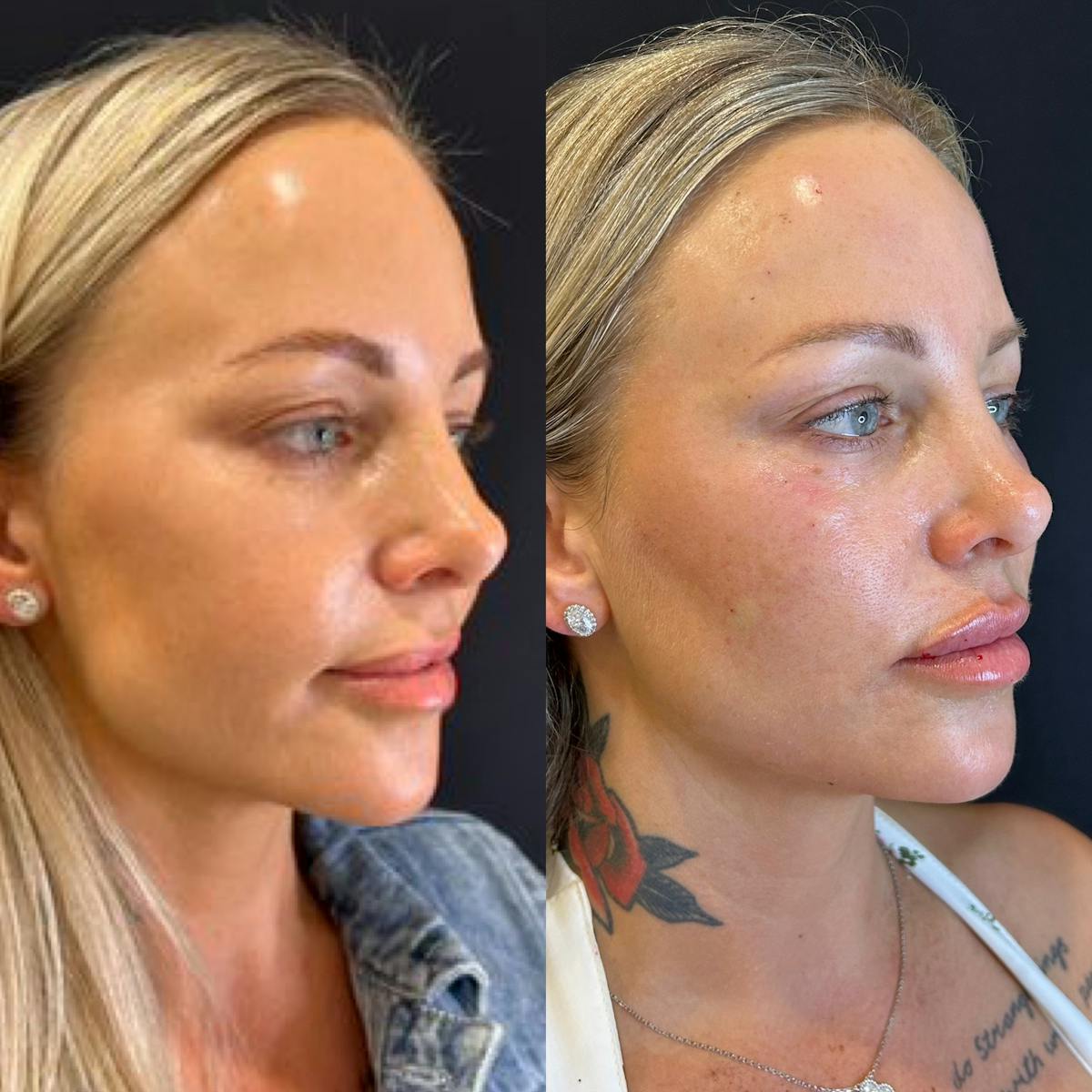 Facial Fillers Before & After Gallery - Patient 328307 - Image 2