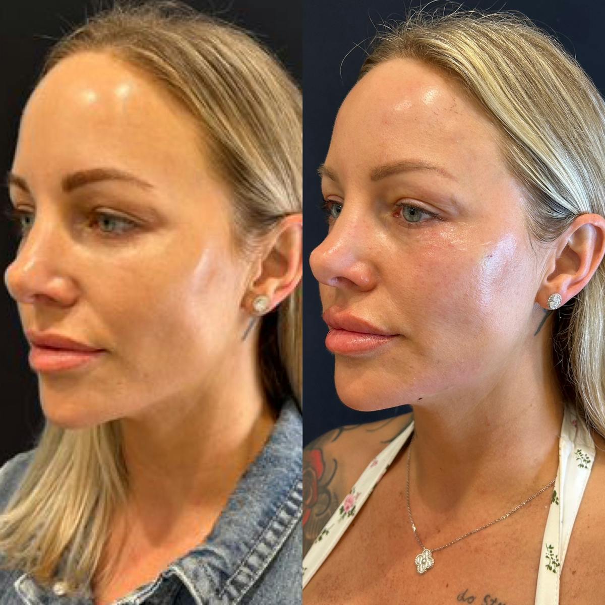 Facial Fillers Before & After Gallery - Patient 328307 - Image 3