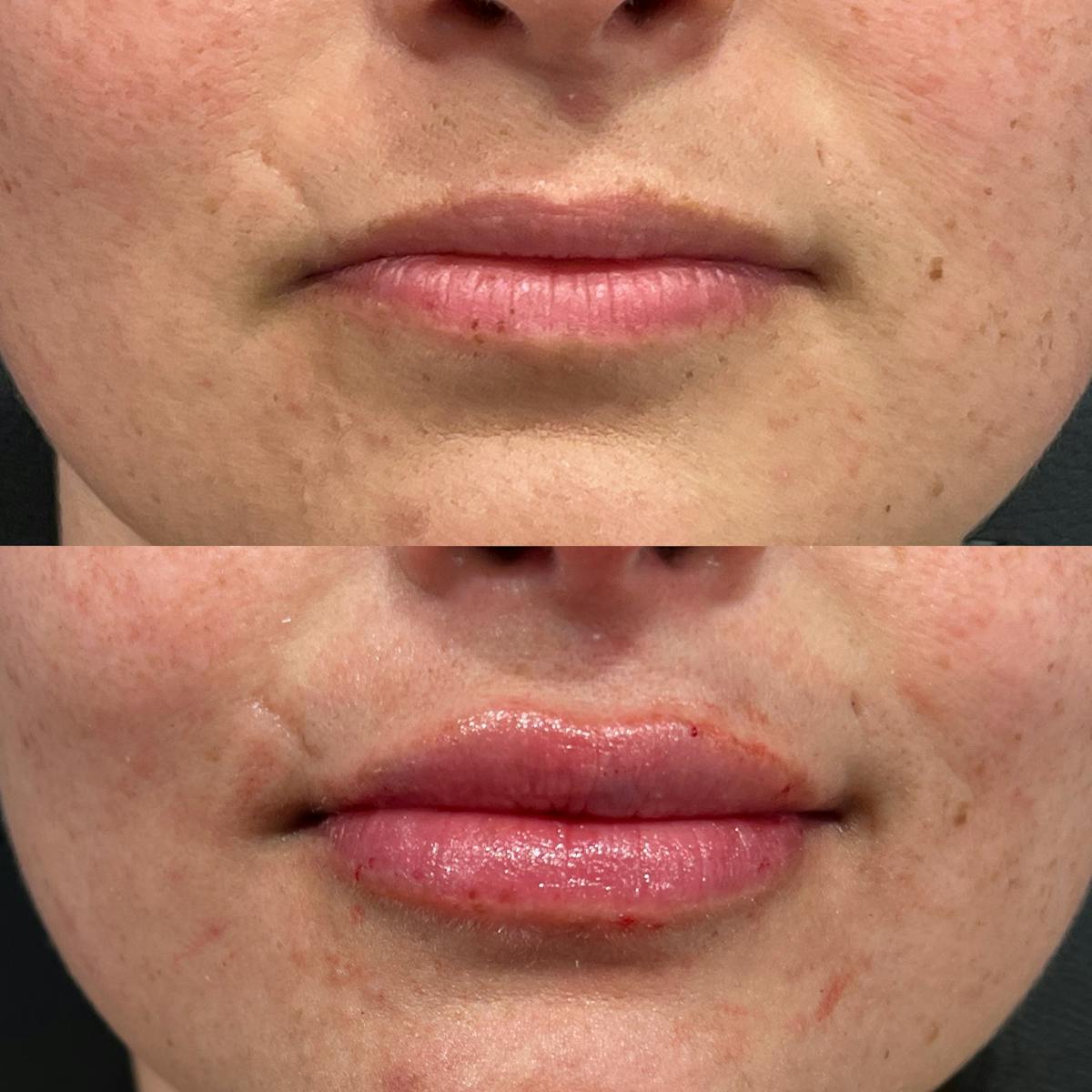 Lip Fillers Before & After Gallery - Patient 310644 - Image 1