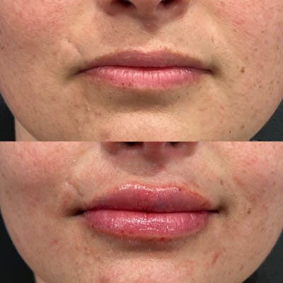 Lip Fillers Before & After Gallery - Patient 310644 - Image 1