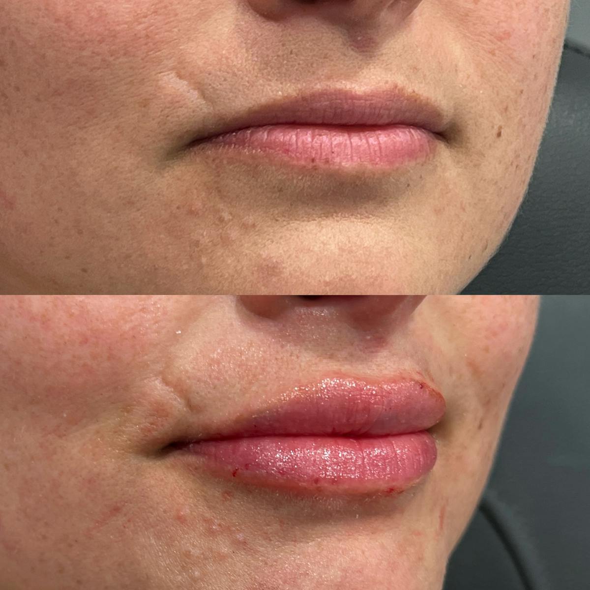 Lip Fillers Before & After Gallery - Patient 310644 - Image 2