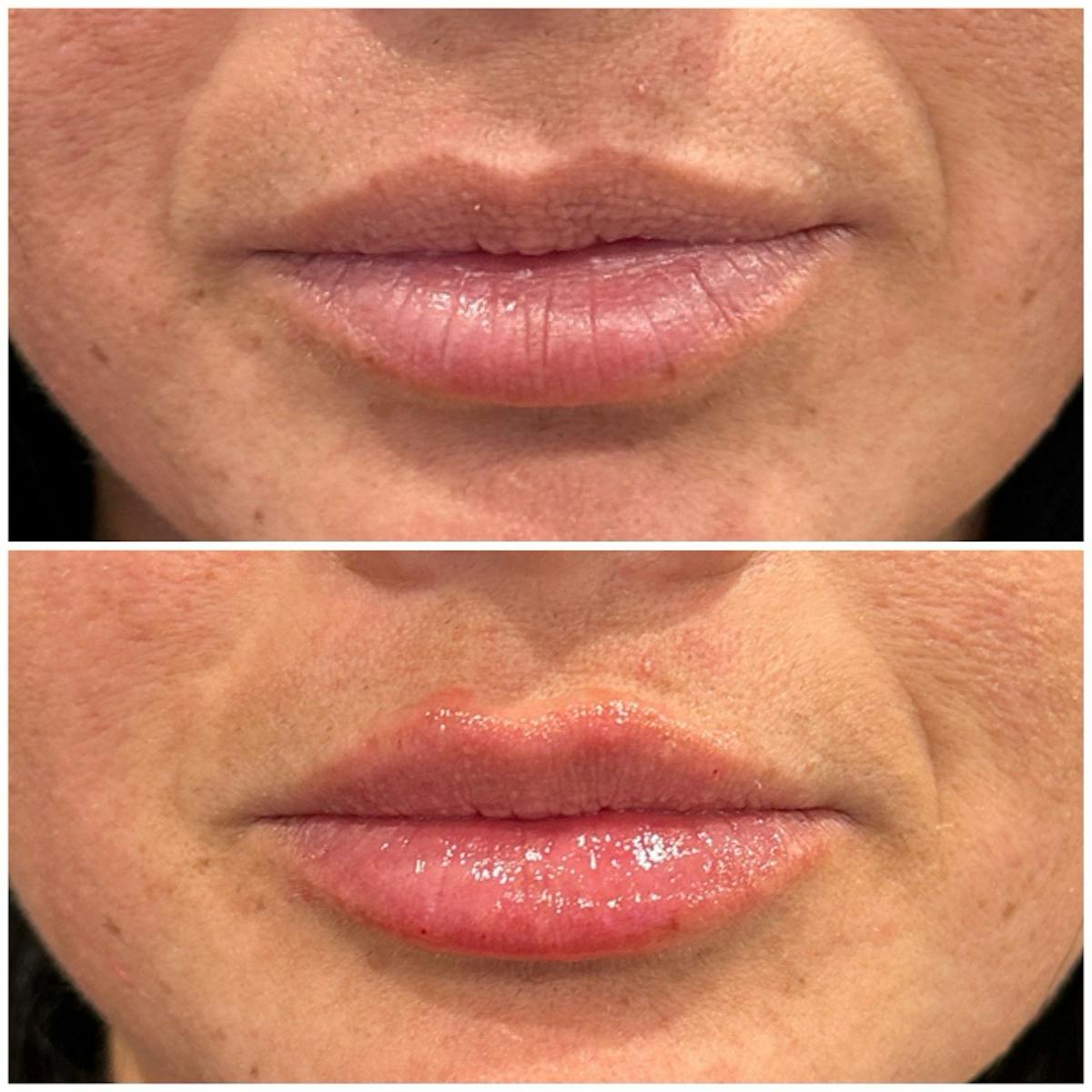 Lip Fillers Before & After Gallery - Patient 206939 - Image 1