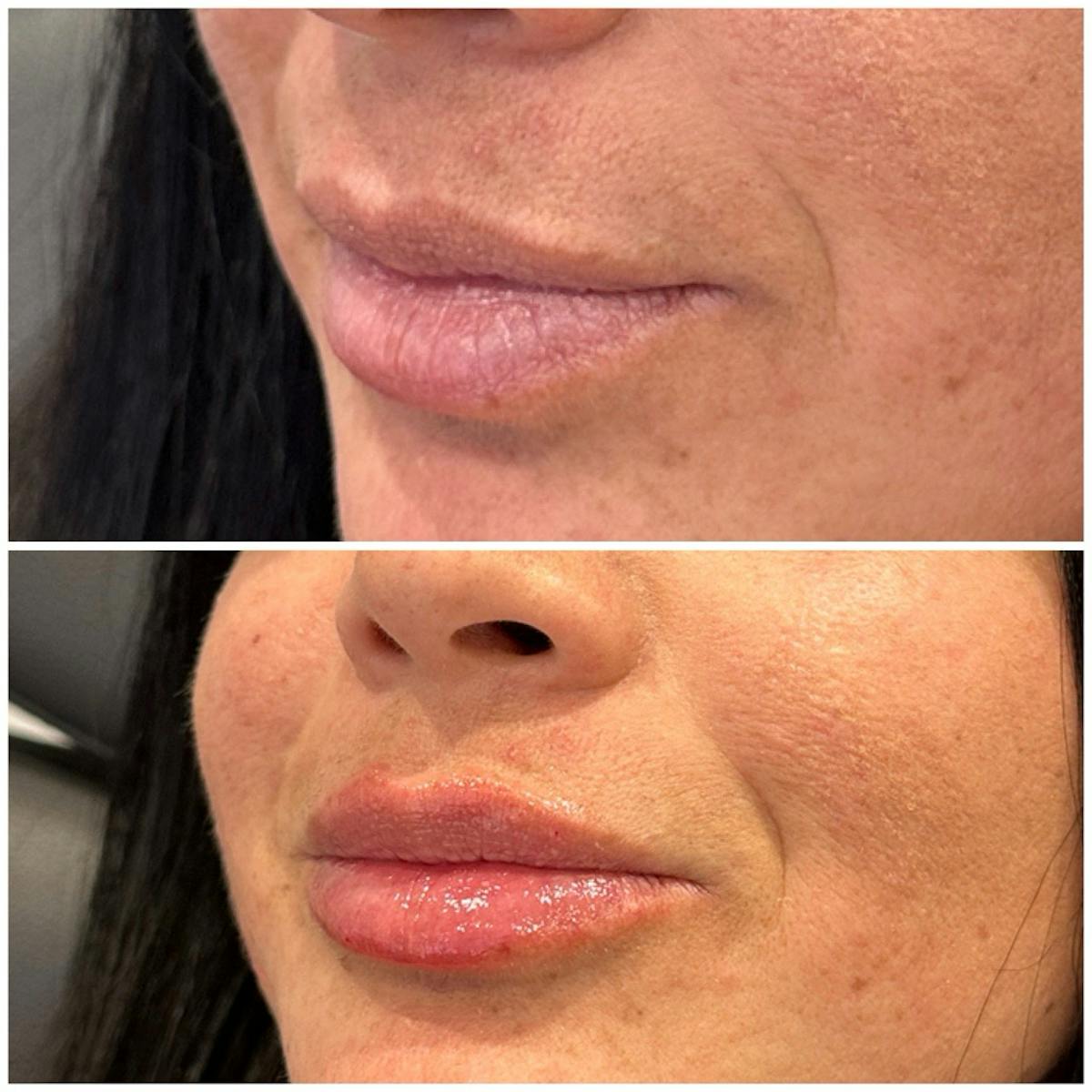 Lip Fillers Before & After Gallery - Patient 206939 - Image 2