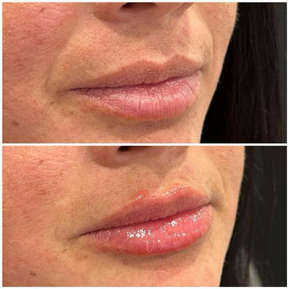 Lip Fillers Before & After Gallery - Patient 206939 - Image 3