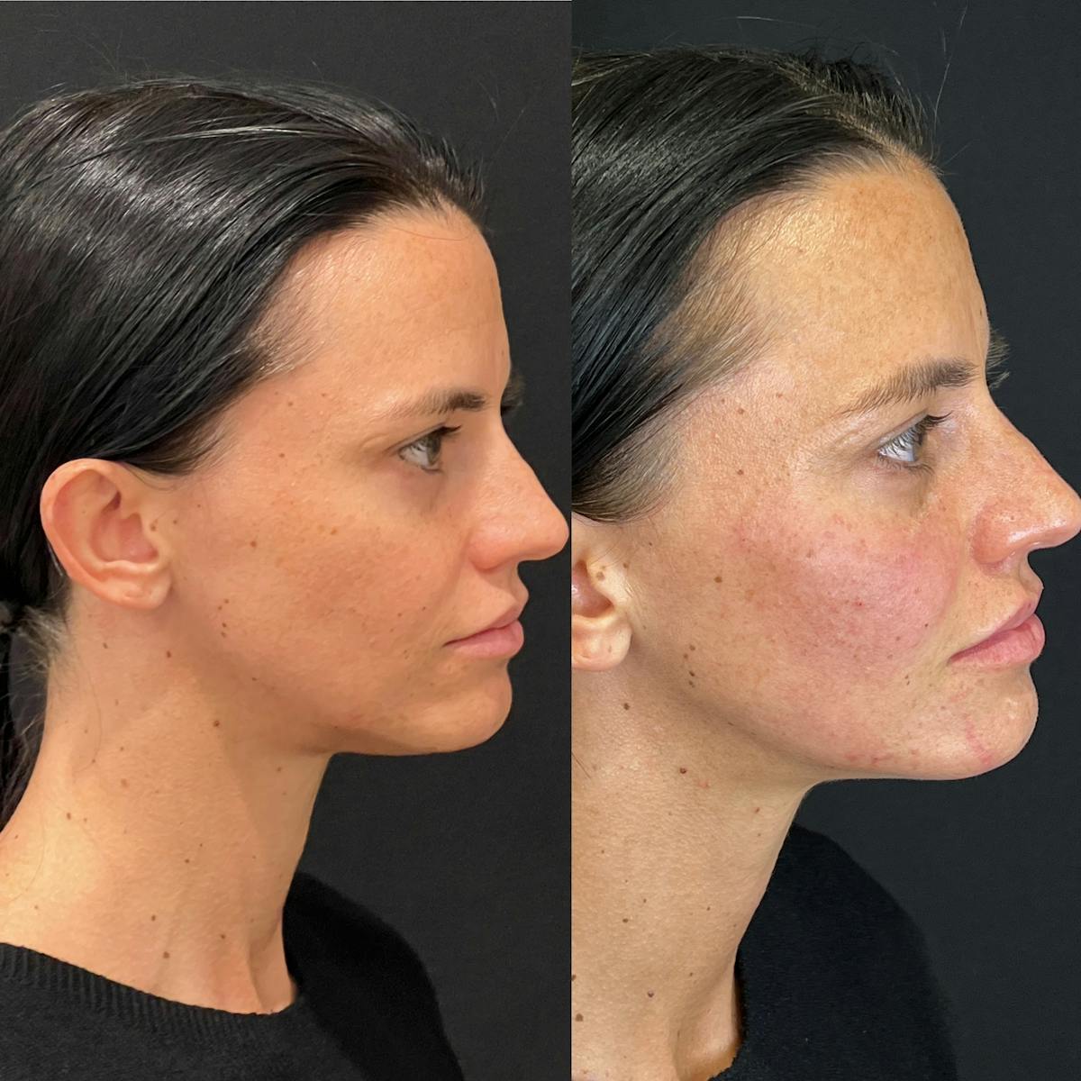 Facial Fillers Before & After Gallery - Patient 240579 - Image 1