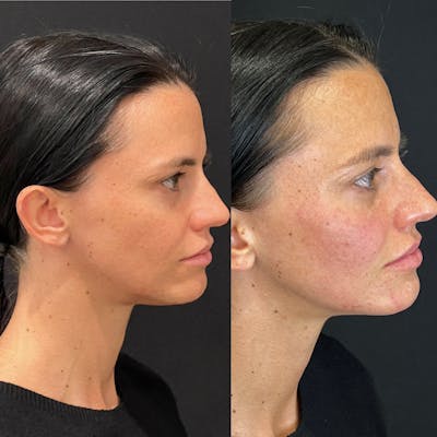 Facial Fillers Before & After Gallery - Patient 240579 - Image 1