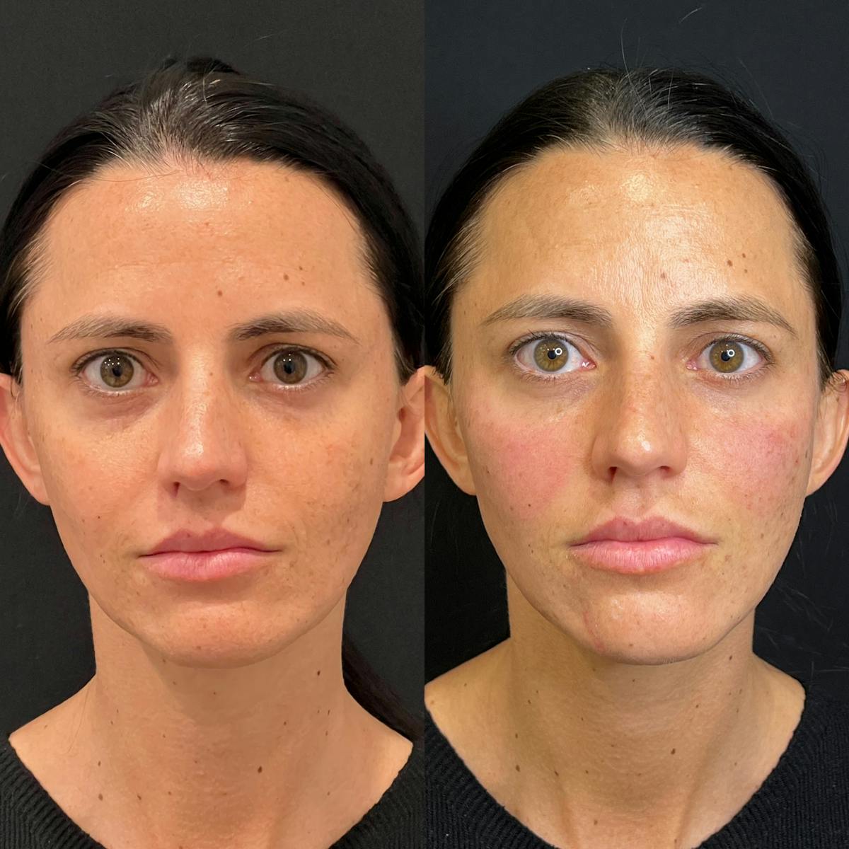 Facial Fillers Before & After Gallery - Patient 240579 - Image 2