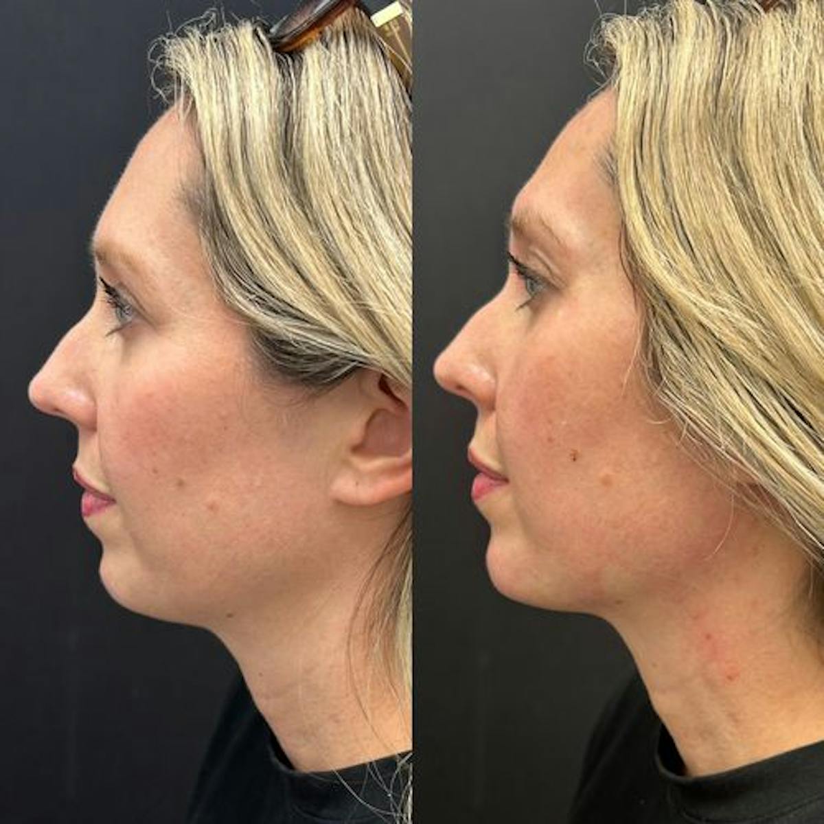 Facial Fillers Before & After Gallery - Patient 170915 - Image 1