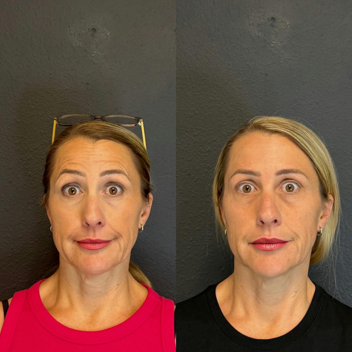 Neurotoxin Before & After Gallery - Patient 141217 - Image 1