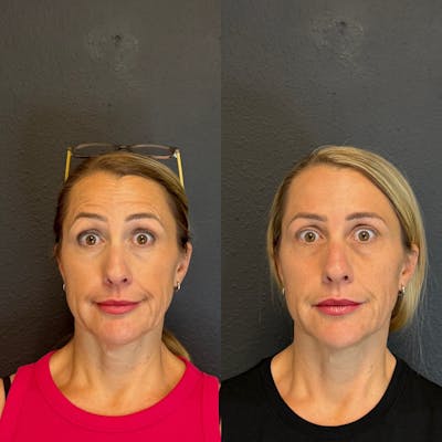 Neurotoxin Before & After Gallery - Patient 141217 - Image 1
