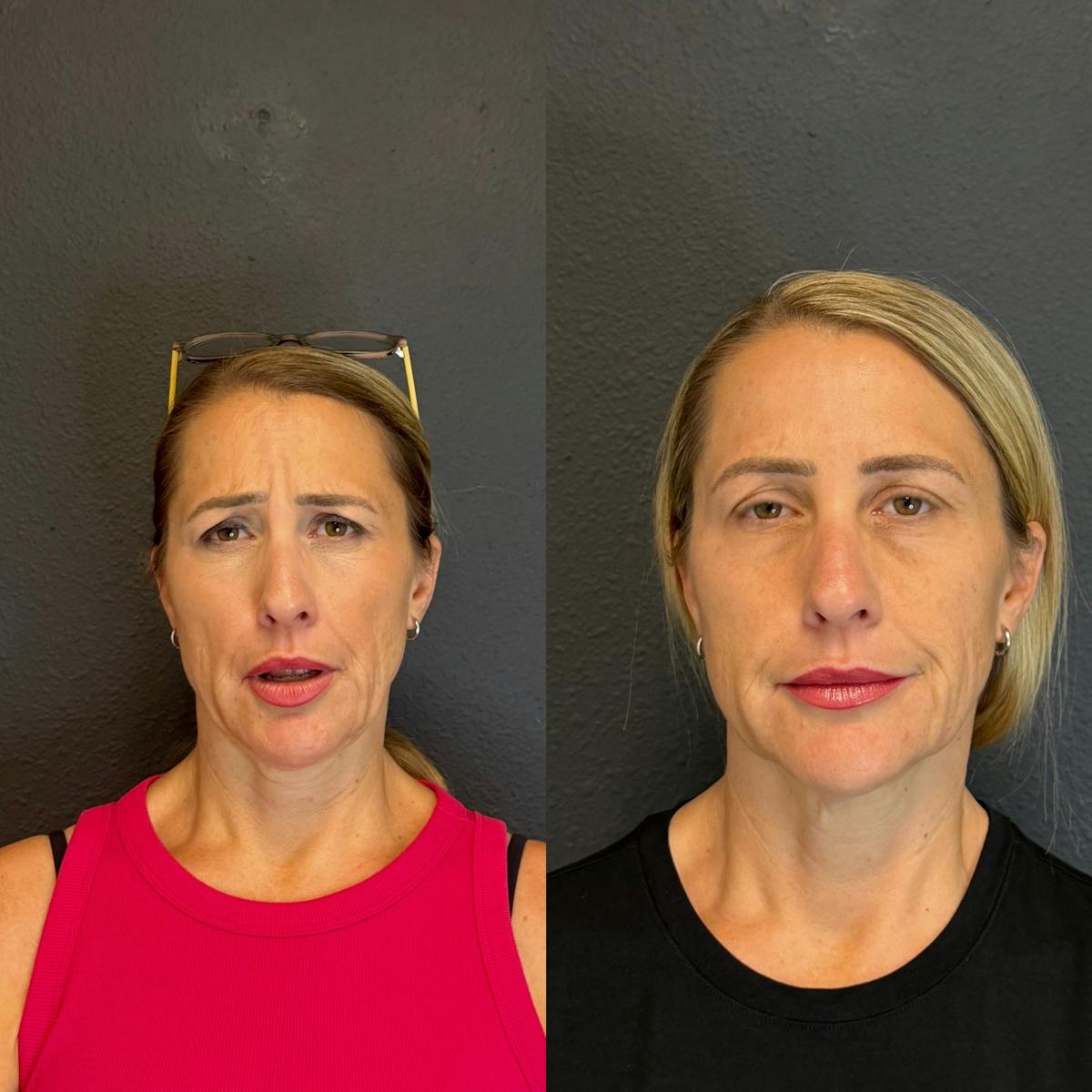 Neurotoxin Before & After Gallery - Patient 141217 - Image 2