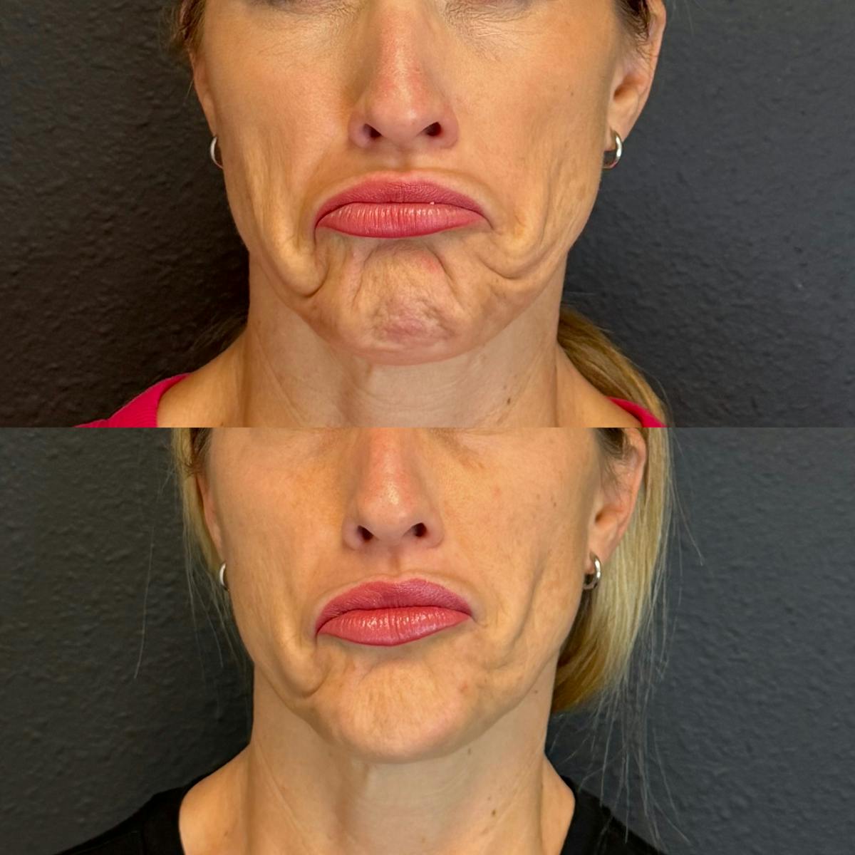 Neurotoxin Before & After Gallery - Patient 141217 - Image 3